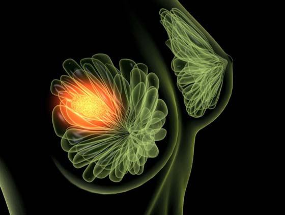 Meme Kanseri Gerçekleri