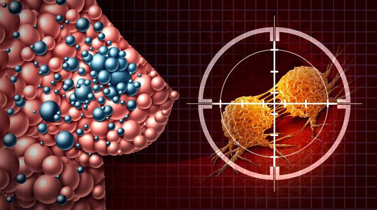 vakalarin yuzde 80inde aile oykusu yok ustelik cogu zaman agrisiz ortaya cikiyor meme sagligi konusunda dogru bilinen yanlislar rTqRaAdl.jpg